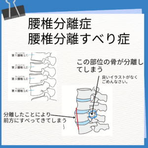 腰椎分離症イメージ